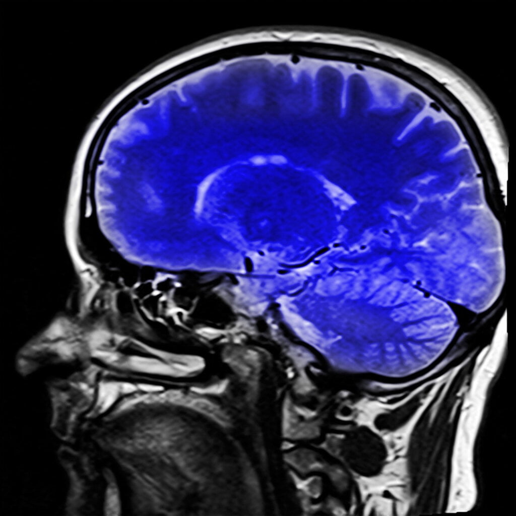 How does Lyme effect the brain?
